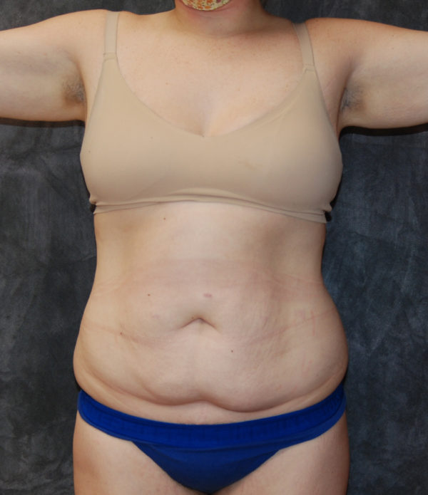 Tummy Tuck