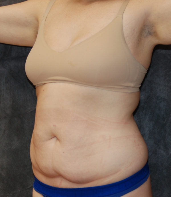 Tummy Tuck