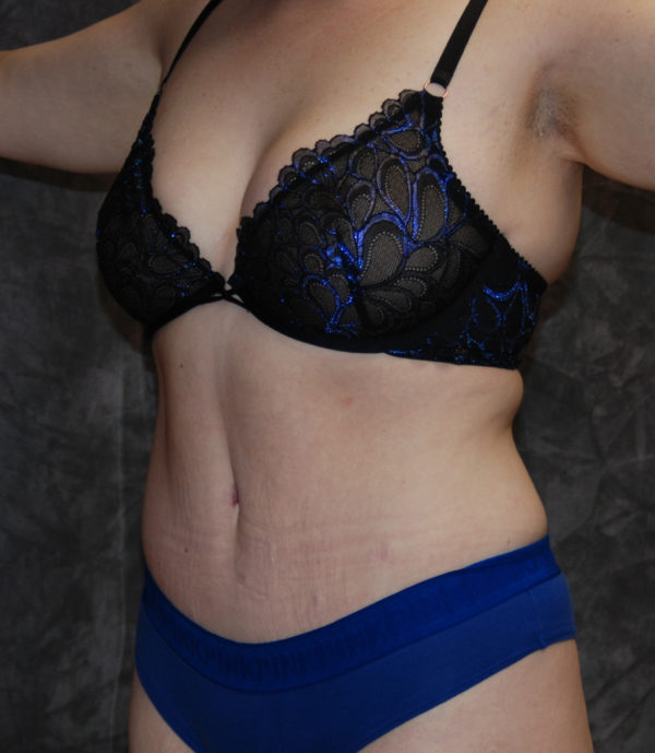 Tummy Tuck