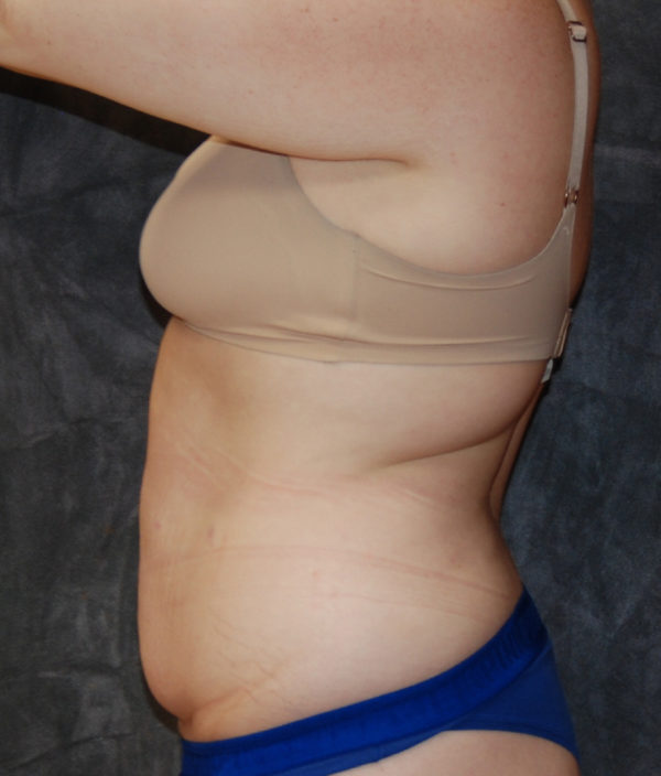 Tummy Tuck