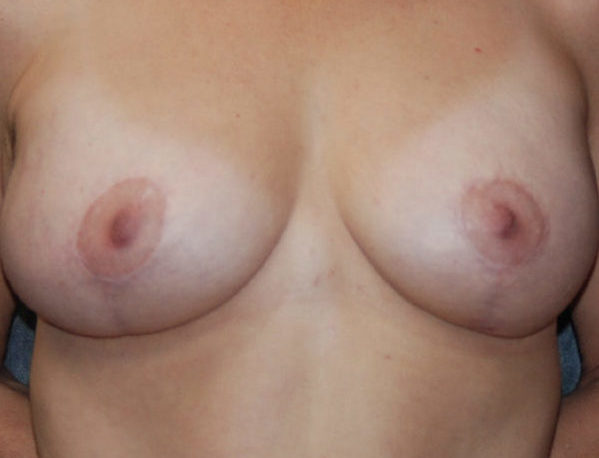 Breast Augmentation