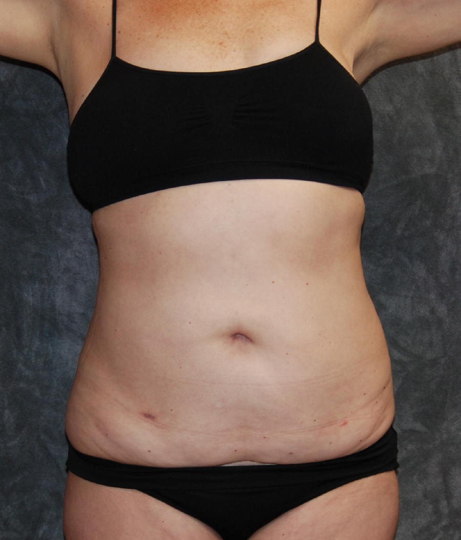 Liposuction Before and After Results