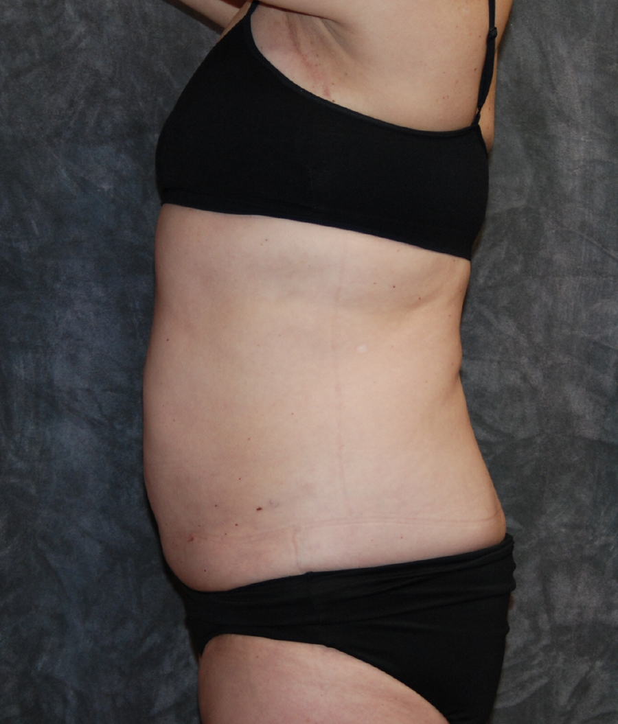Liposuction procedure after photo in Philadelphia by Dr. Lohner