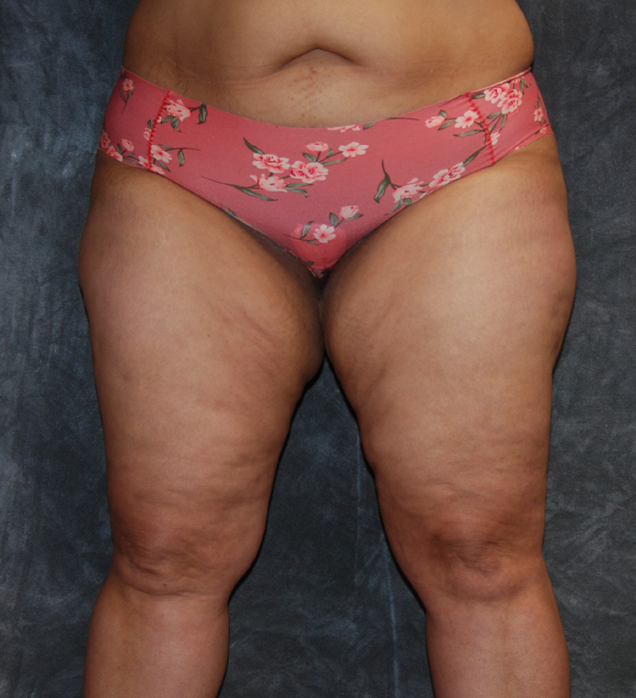 Thigh Lift Before and After Results