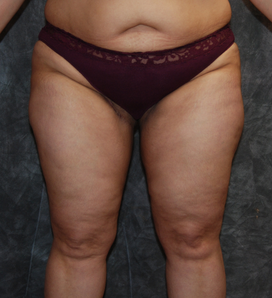 Cellulite Reduction Before and After Results