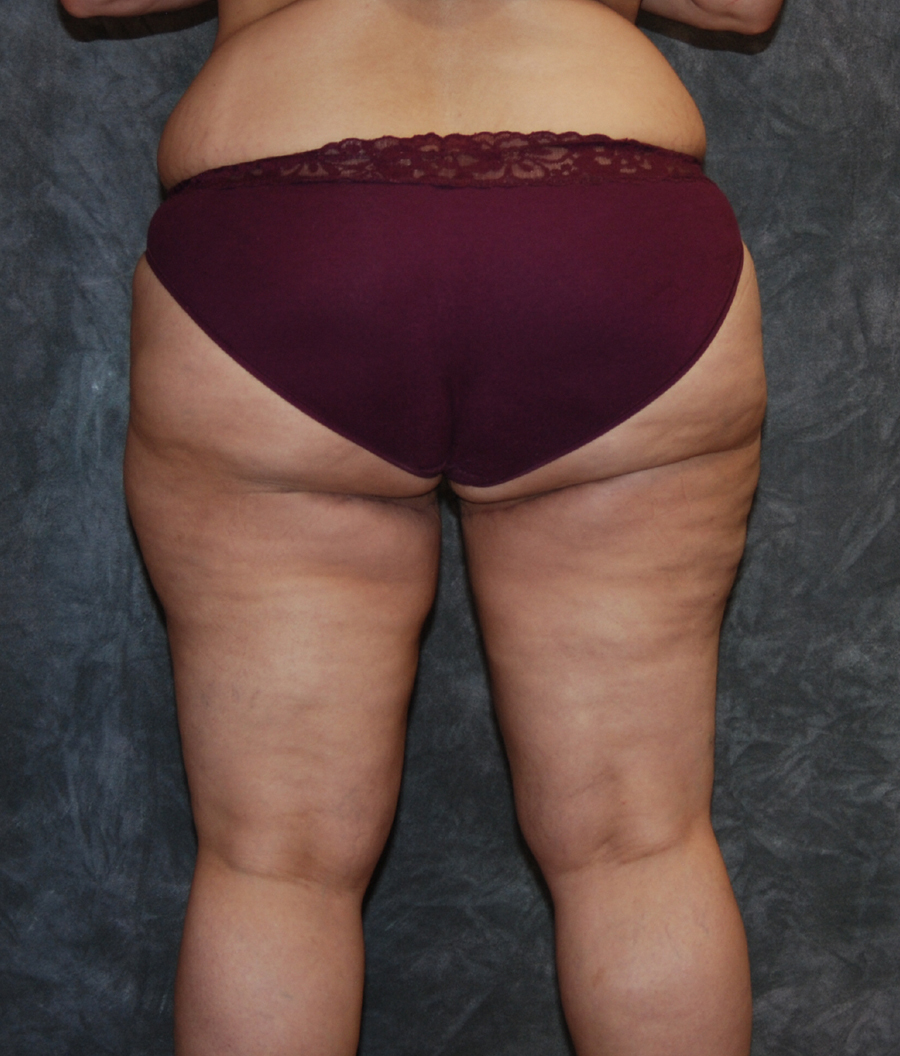 thigh lift before and after photos in Philadelphia