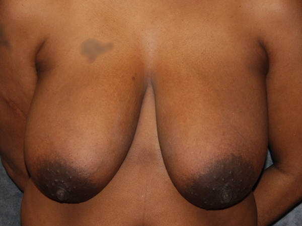 Breast Reduction