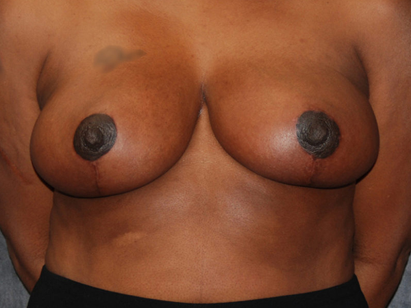 Breast Reduction