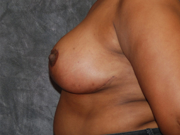 Breast Reduction