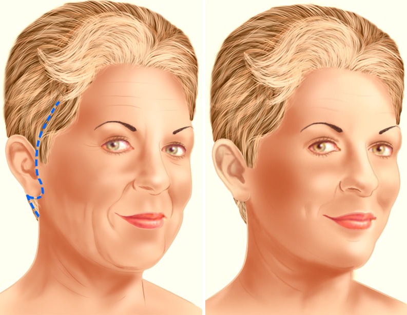 facelift risks and complications
