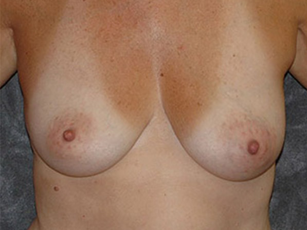 Breast Augmentation