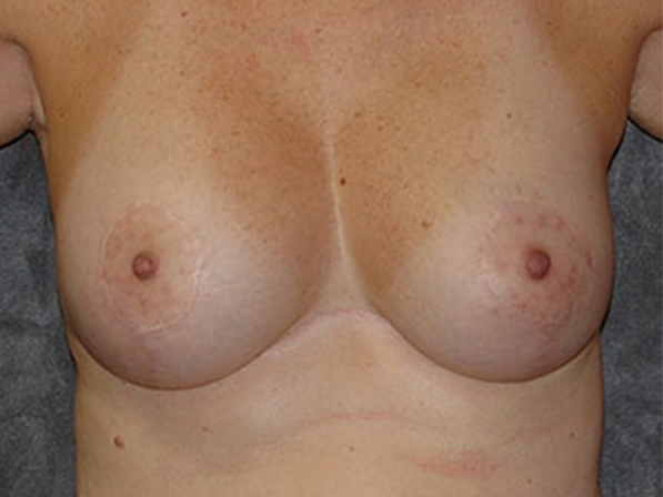 Breast Augmentation