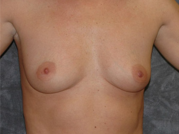 Breast Augmentation