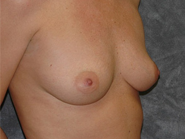 Breast Augmentation