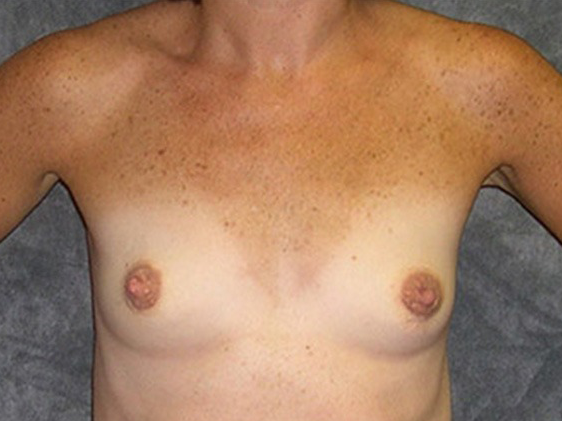 Breast Augmentation