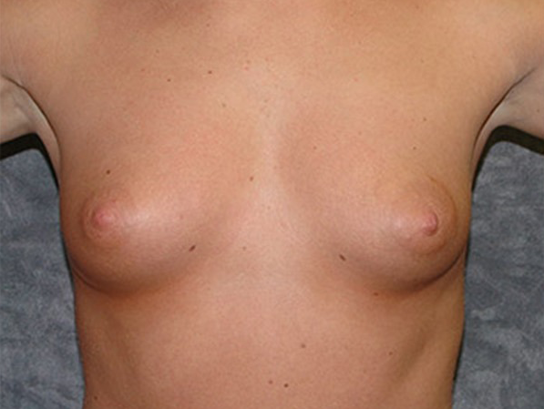 Breast Augmentation