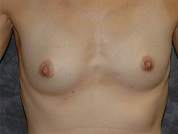 Breast Augmentation