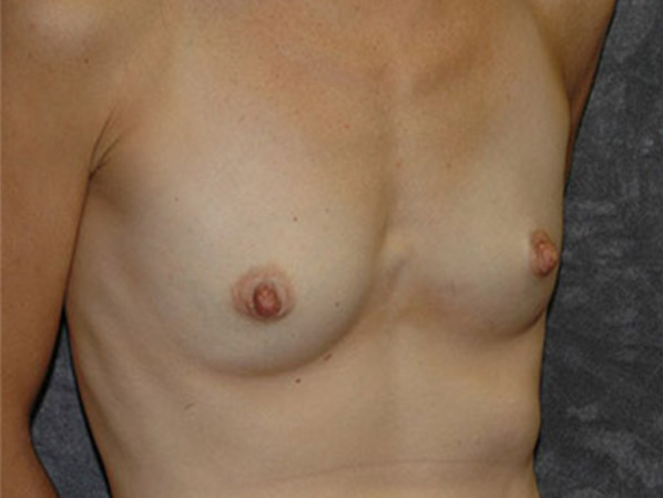 Breast Augmentation