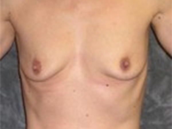 Breast Augmentation