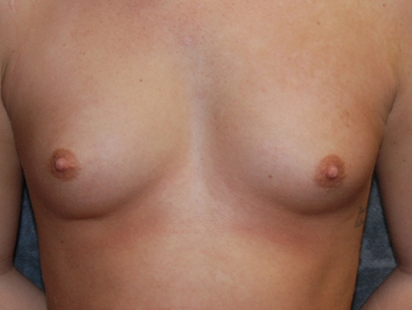 Breast Augmentation