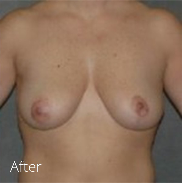 Breast Reduction