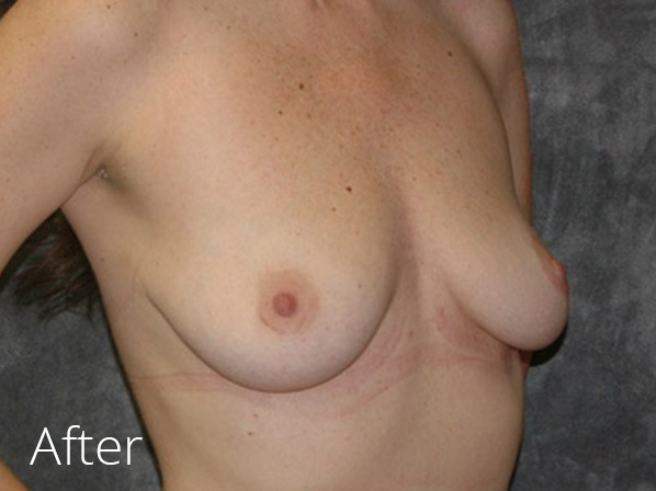 Breast Implant Removal