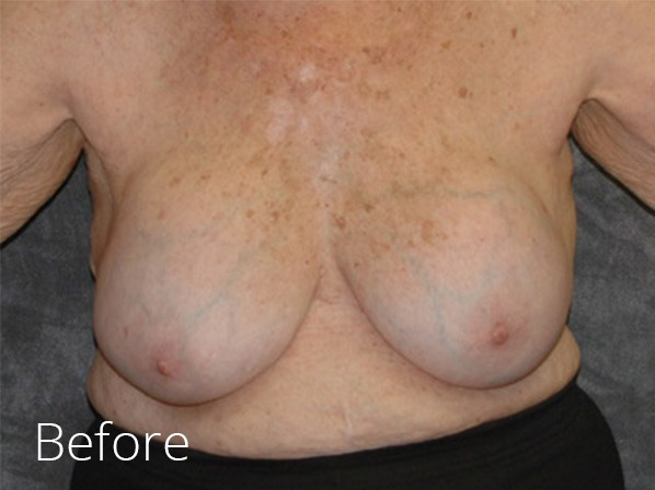 Breast Implant Removal