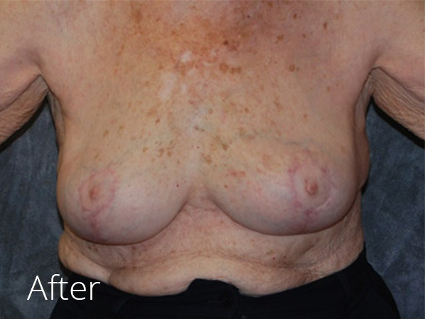 Breast Implant Removal