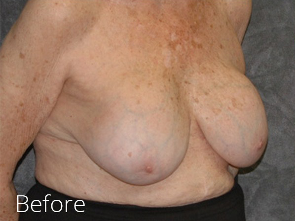 Breast Implant Removal