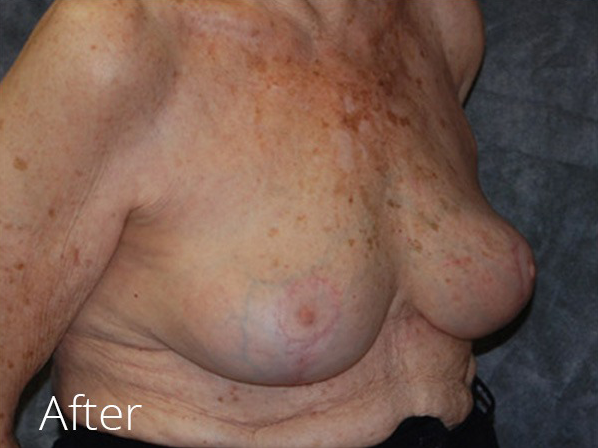 Breast Implant Removal