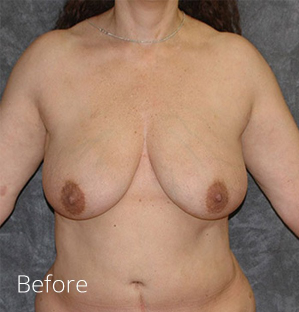 Breast Lift