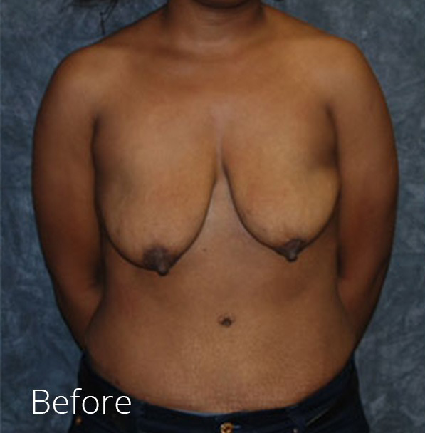 Breast Lift