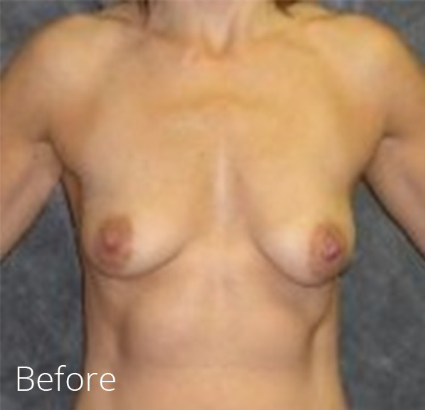 Breast Lift