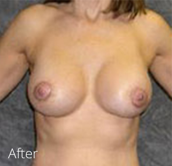 Breast Lift