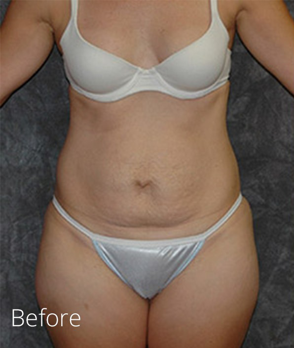 Tummy Tuck