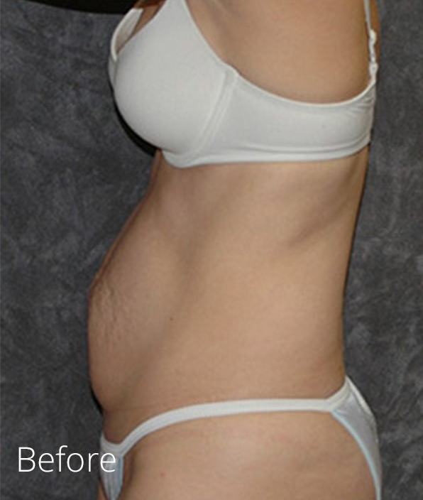 Tummy Tuck