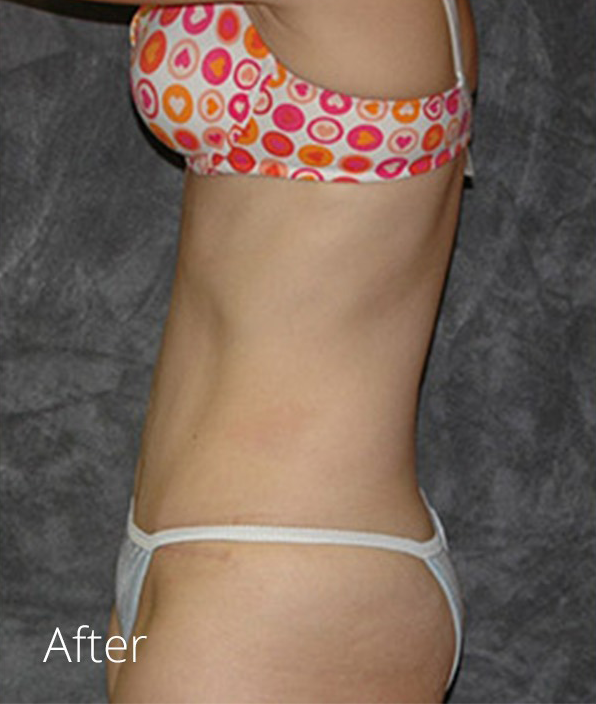 Tummy Tuck