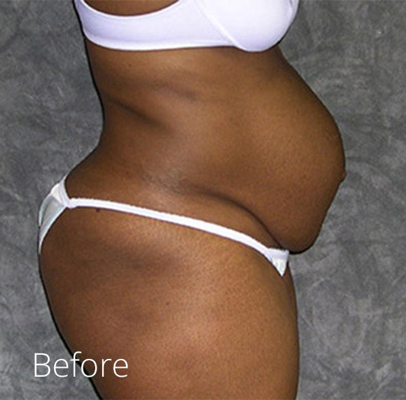 Tummy Tuck