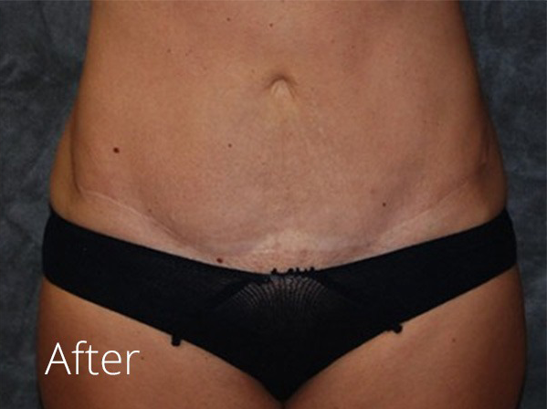 Tummy Tuck