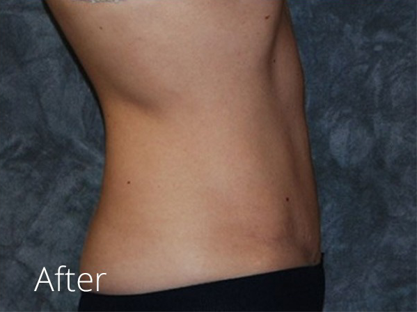 Tummy Tuck