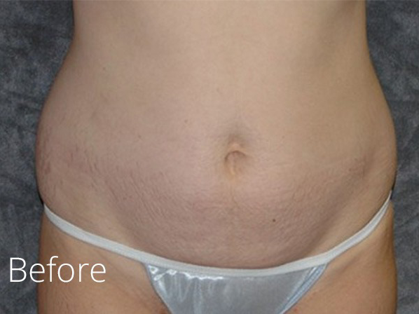 Tummy Tuck