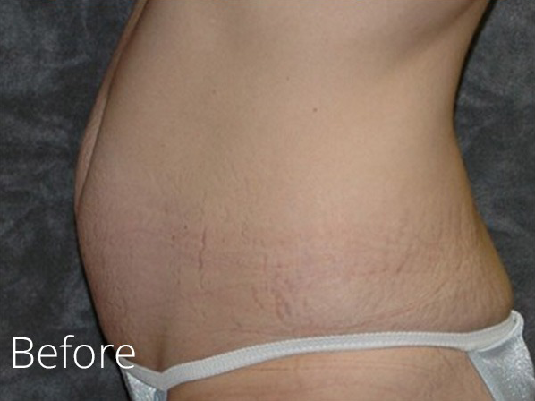 Tummy Tuck