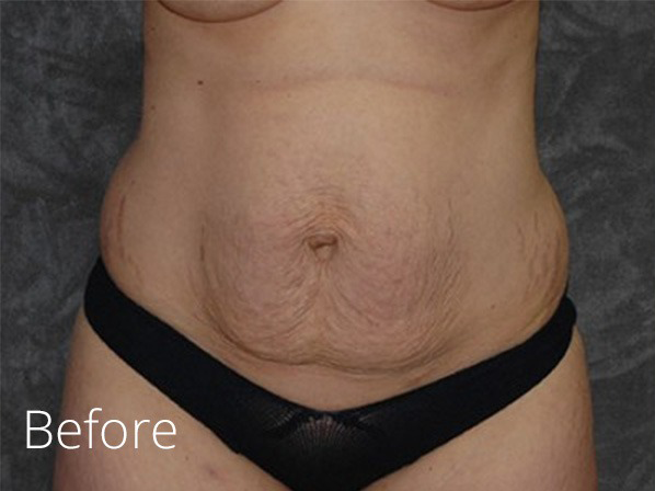 Tummy Tuck