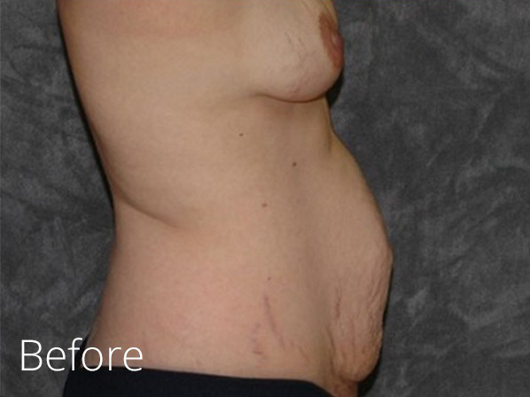 Tummy Tuck