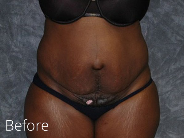 Tummy Tuck