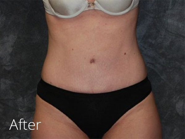 Tummy Tuck