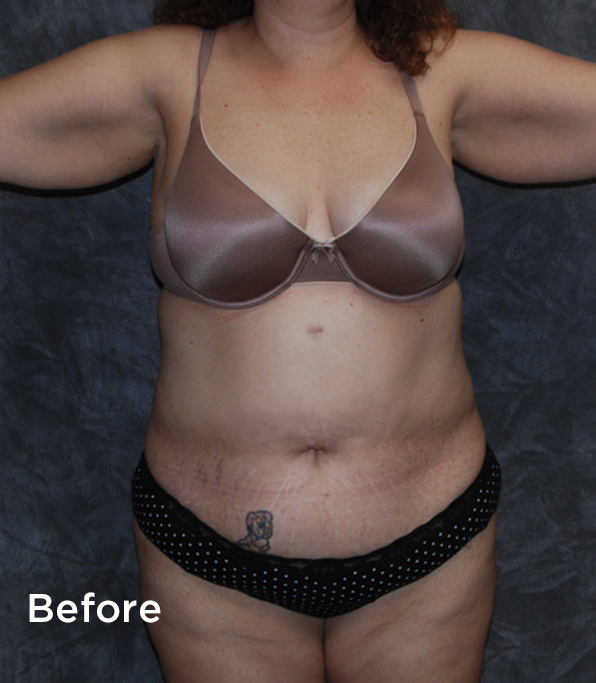 Tummy Tuck