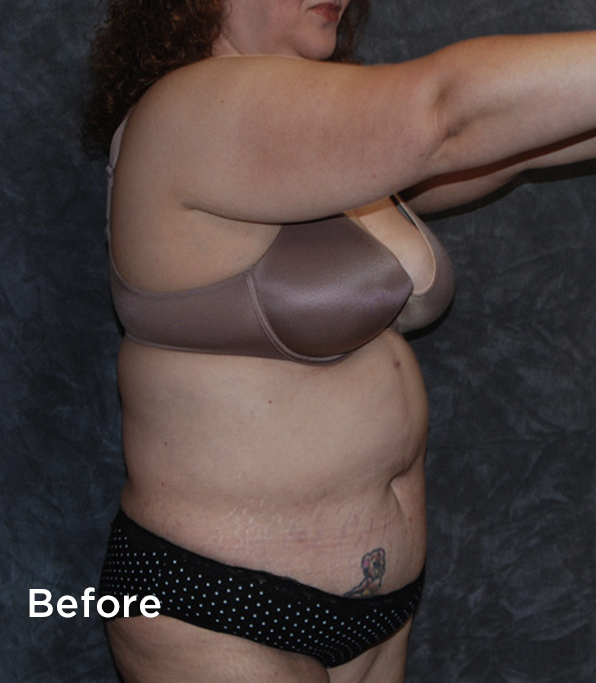 Tummy Tuck