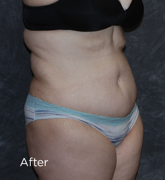 Tummy Tuck