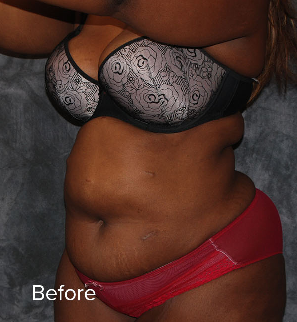 Tummy Tuck